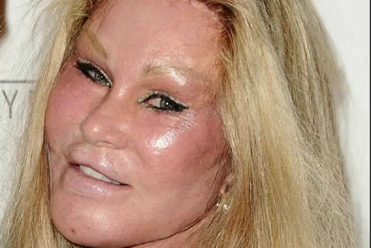 Six Worst Celebrity Cosmetic Surgery DISASTERS