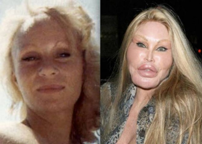 Jocelyn Wildenstein before and after plastic surgery. 