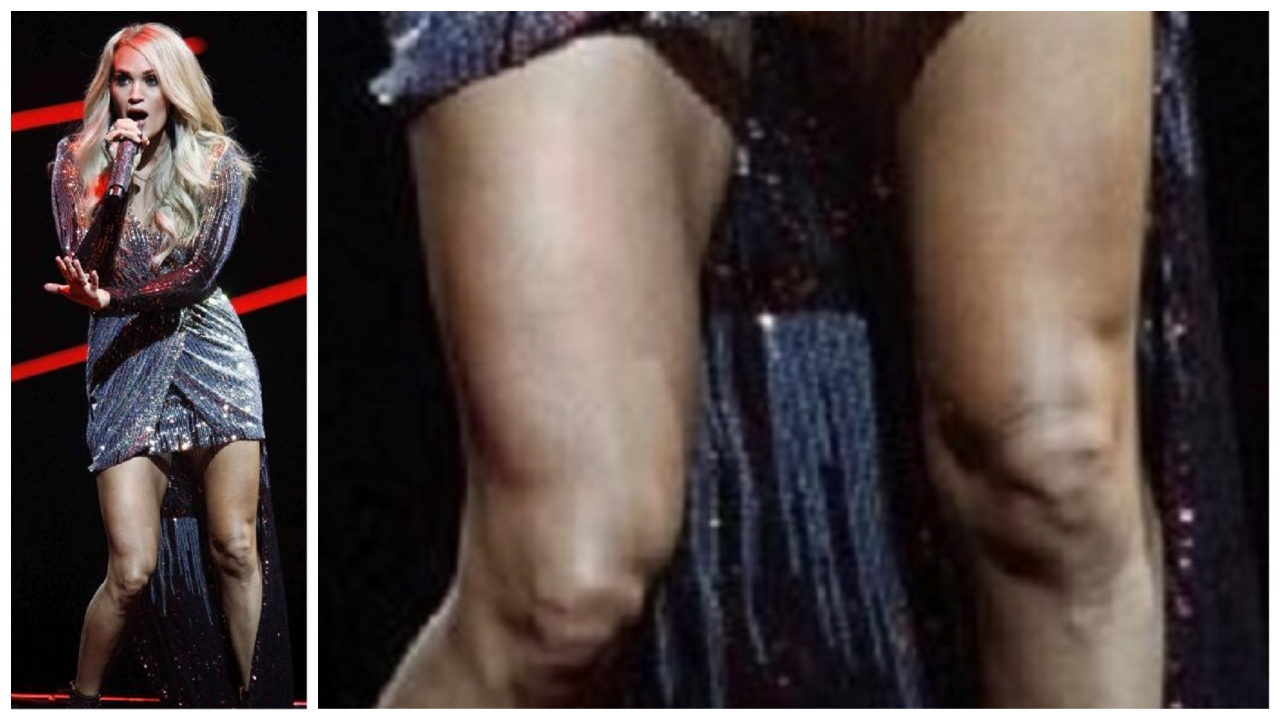 Carrie Underwood's Knee