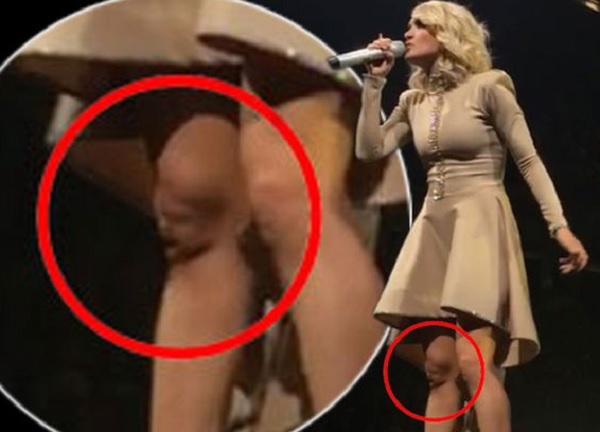 Carrie Underwood's Knee